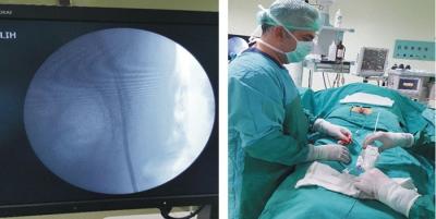 Bel F�t�klar�nda Lazerli Epiduroskopi Y�ntemi